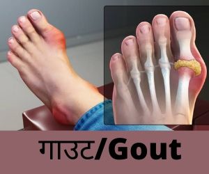 गाउट/Gout